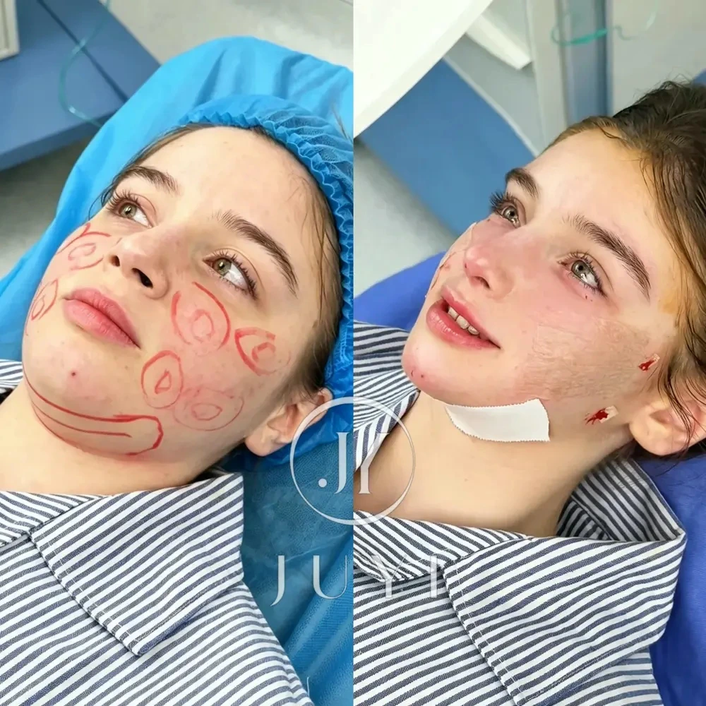 ARCrefinelift Immediate Surgical Transformation