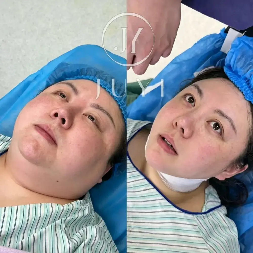 ARCrefinelift™ Facial Restoration Case 2