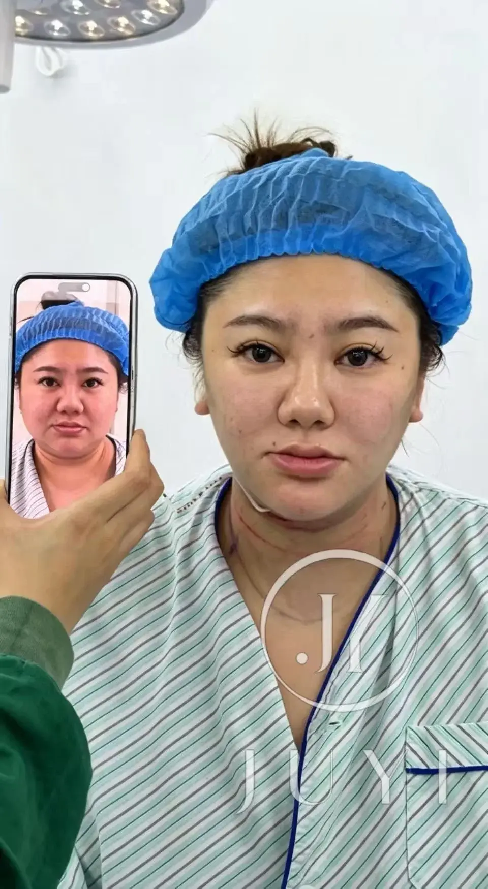 ARCrefinelift™ Facial Restoration Case 5