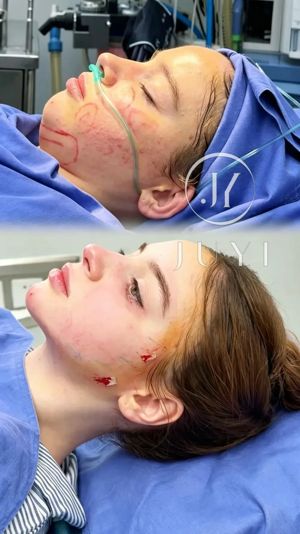 ARCrefinelift™ Facial Restoration Case 8