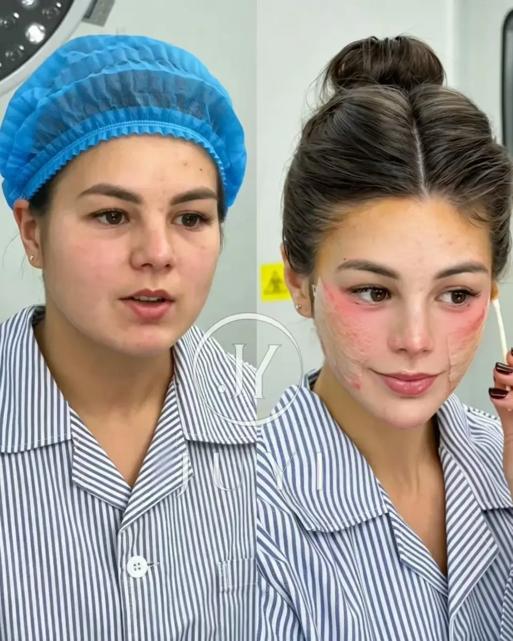 ARCrefinelift™ Facial Restoration Case 9