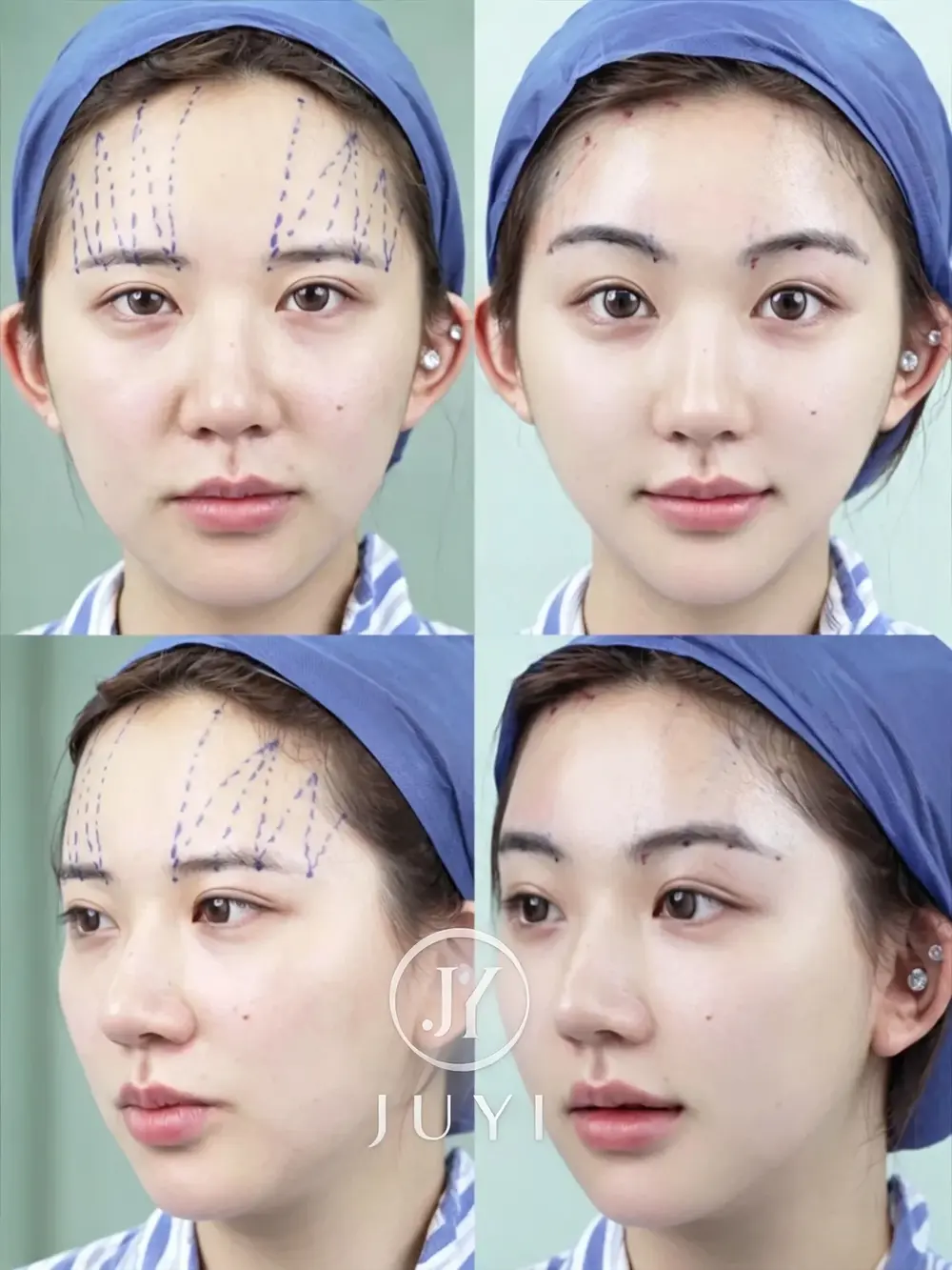 ARCrefinelift™ Facial Restoration Case 10