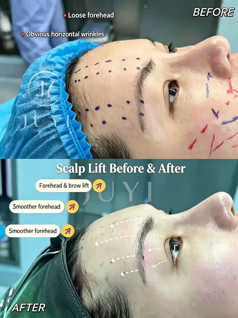 ARCrefinelift™ Facial Restoration Case 12