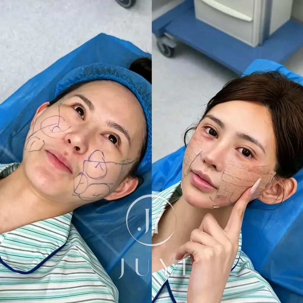 ARCrefinelift™ Facial Restoration Case 13